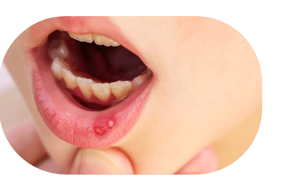 Aftas en el labio del niño