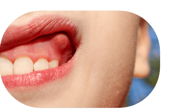 Fibroma en la boca: herida en la boca
