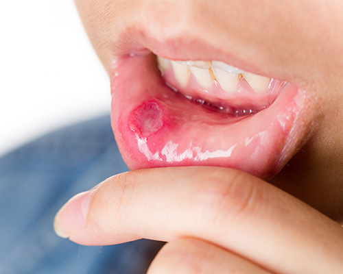 Frau mit einer Verletzung an der Lippe im Mund.