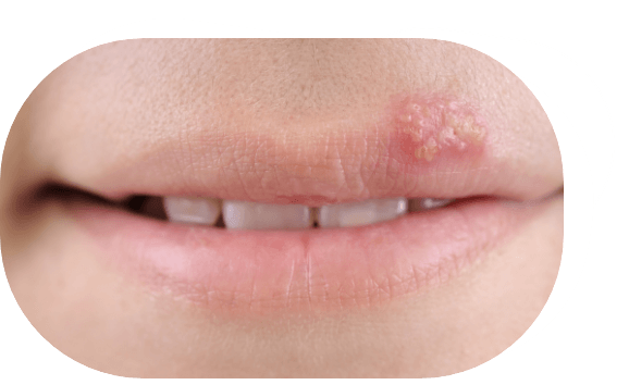 Herpes an der Lippe eines Kindes. Dynexan Mundgel hilft bei Schmerzen durch Herpes.