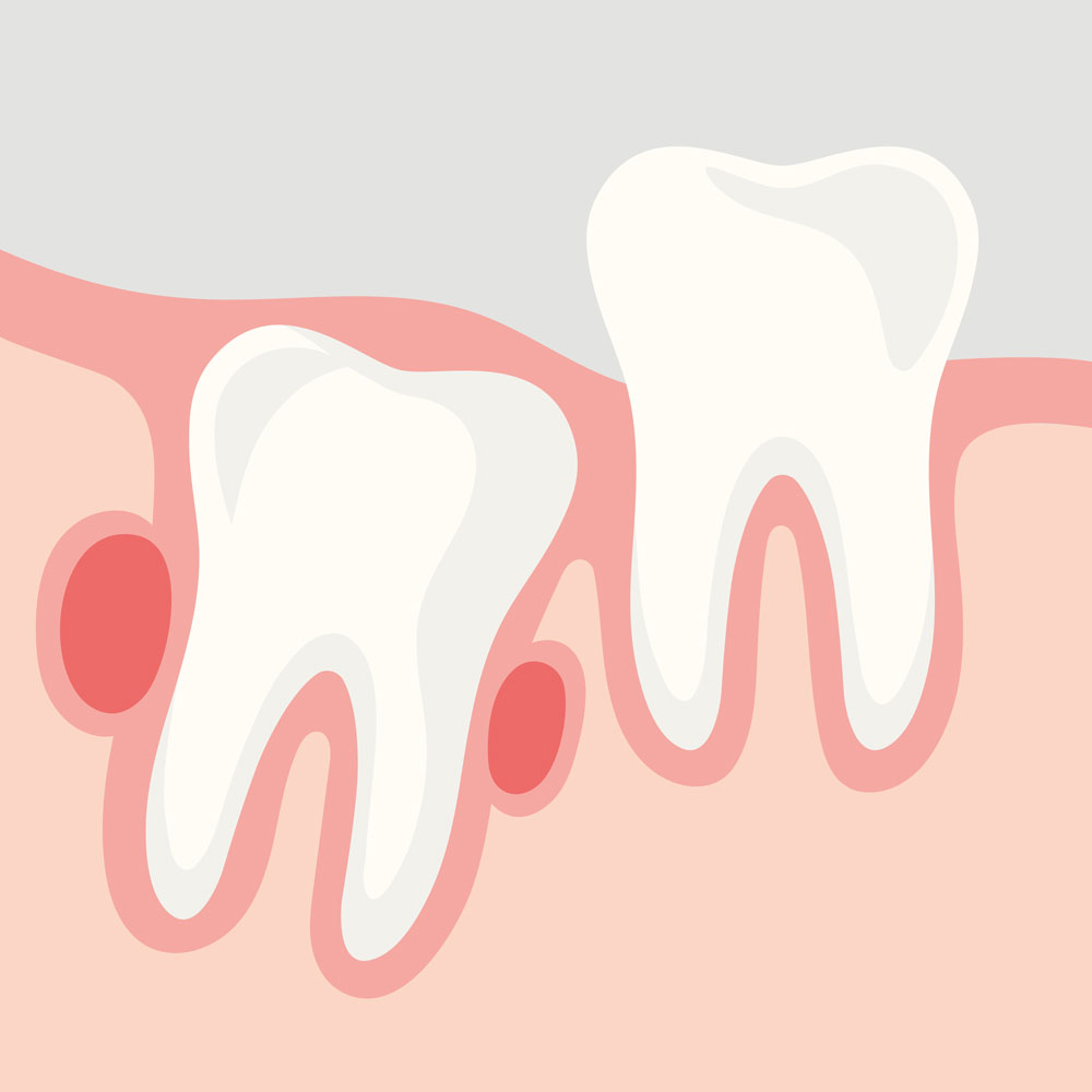 Zystenbildung am Zahnfleisch rund um einen retinierter Weisheitszahn