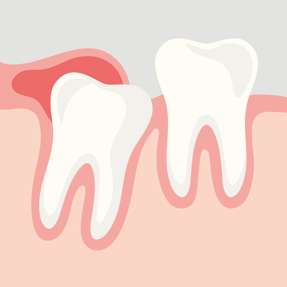 Infektion aufgrund eines teilretinierten Weisheitszahns